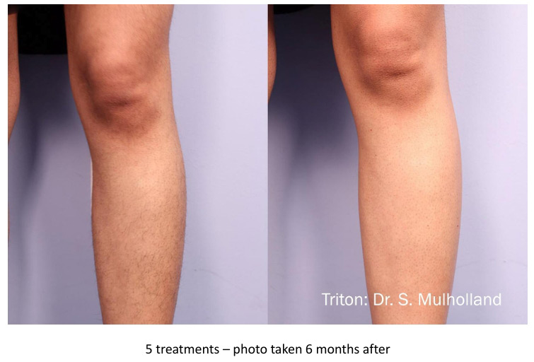 Triton-Dark-leg